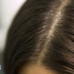 درمان شوره سر بر اساس بافت و مو