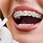 ارتودسنی بزرگسالان و بهترین سن انجام آن