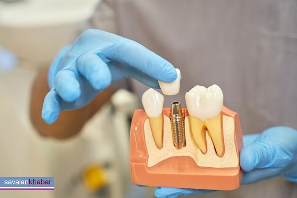 دندان ایمپلنت implant dentist